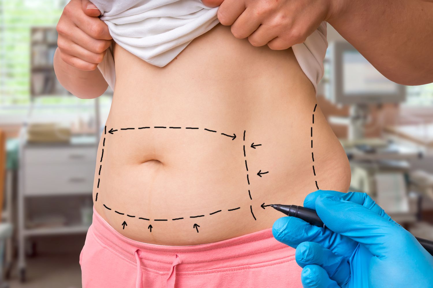 Bariatric Surgery hospital in Bangalore