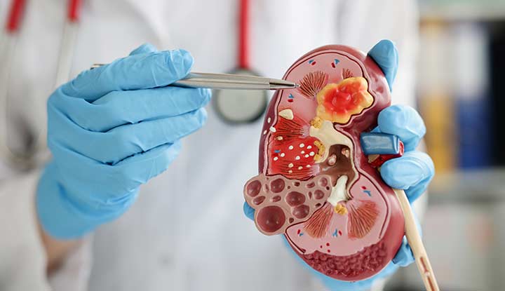 Nephrology Treatment